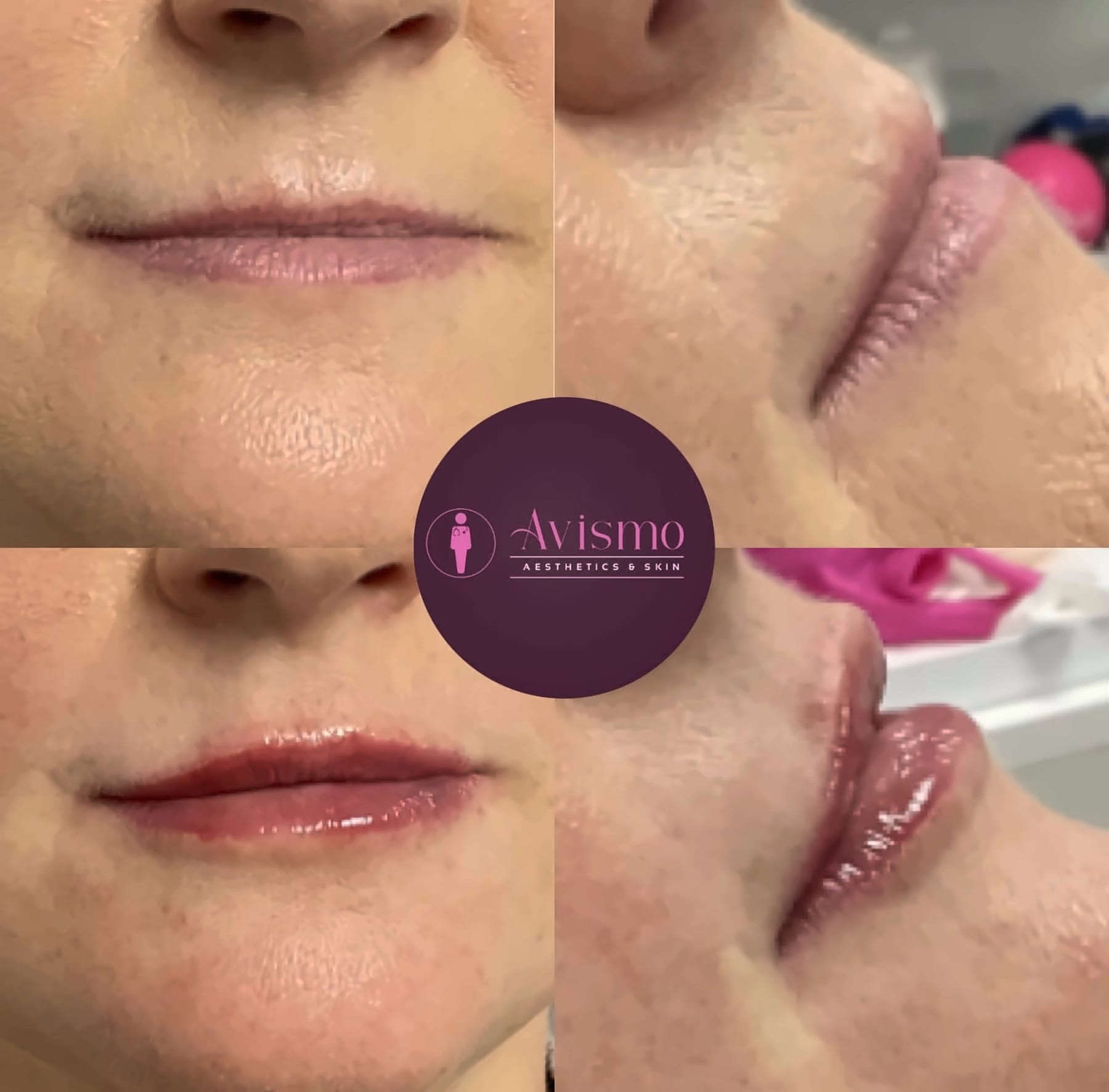 Before and after lip filler at Avismo Aesthetics and Skin, St Ives