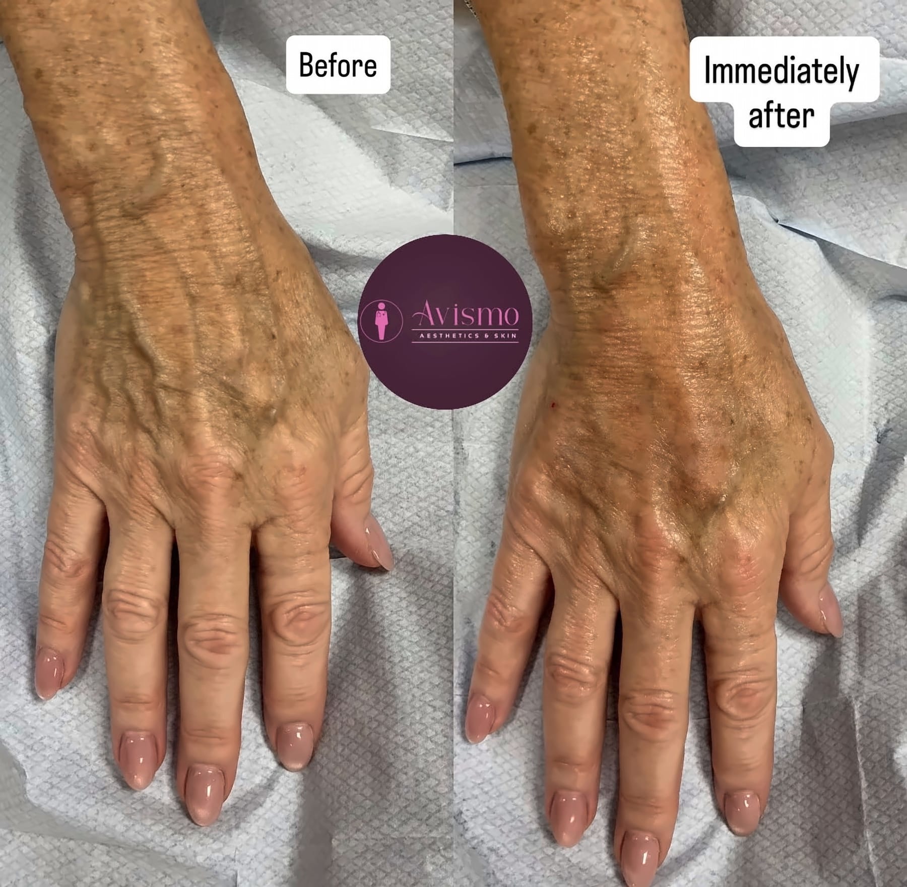 Before and after hand rejuvenation with radiesse at Avismo Aesthetics and Skin, St Ives