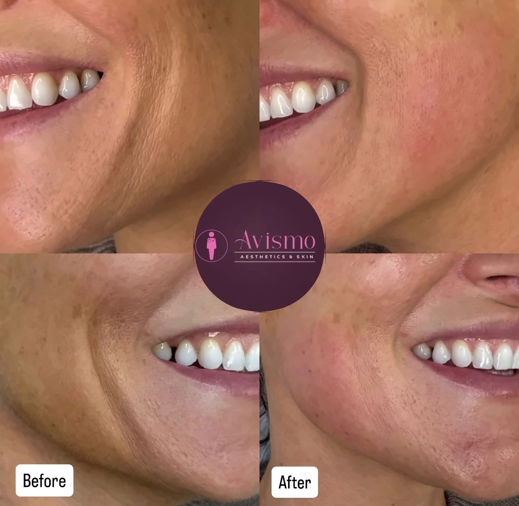 Before and after smile lines with rha 1 filler at Avismo Aesthetics and Skin, St Ives