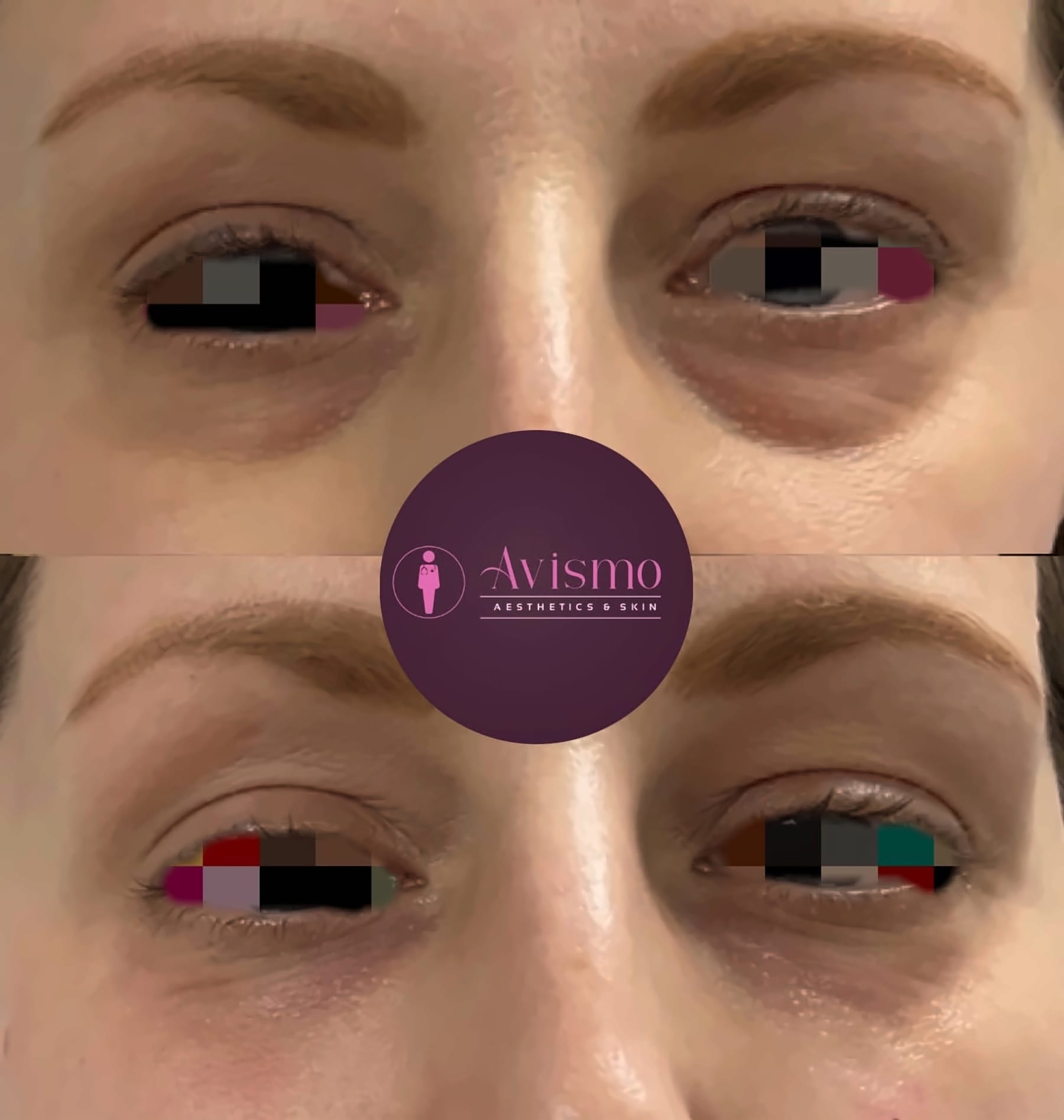 Before and after tear trough filler at Avismo Aesthetics and Skin, St Ives